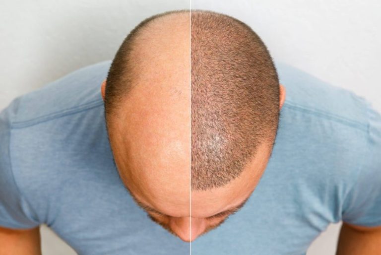 Hair Surgery Clinic in Istanbul: Your Guide to Hair Transplant in Turkey