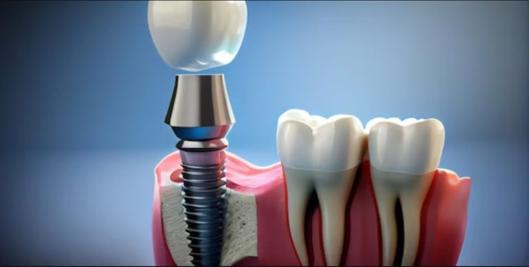The Key to a Perfect Smile: Why Choosing an Orthodontist Matters